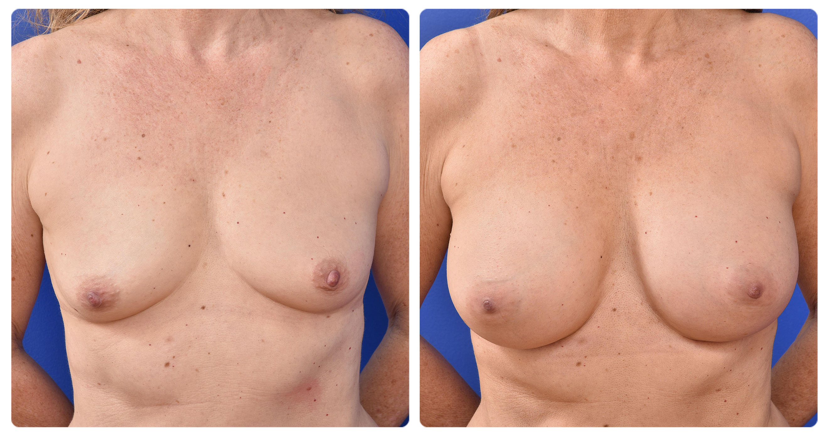 https://www.capsclinic.com.au/capsclinic/wp-content/uploads/sites/3/2019/01/BA-template_Breast-Aug-small-breast9_v2.jpg