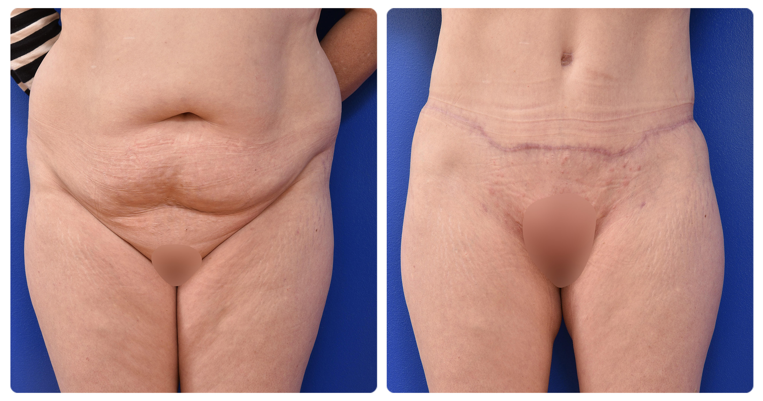 Abdominoplasty - The CAPS Clinic Canberra