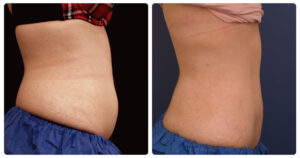 CoolSculpting Before and After - Frosted Away Clinic Canberra