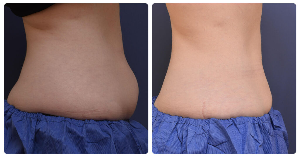 CoolSculpting Before and After - Frosted Away Clinic Canberra