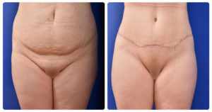 Postpartum Abdominoplasty with Dr Taylor at the CAPS Clinic
